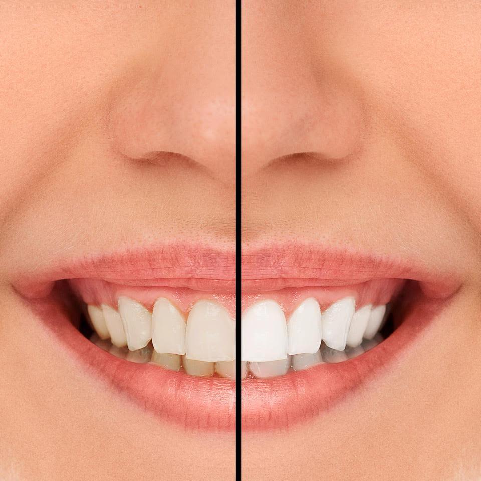 Oralgen NuPearl Stylo Blanchiment Dentaire Professionnel - mondialpharma.com